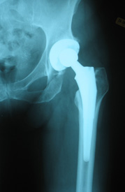 X-rays of hips after hip replacement surgery.